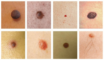 Les plus courantes des taches sur la peau est une taupe et le papillomavirus (verrues)