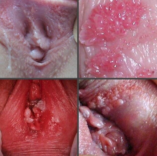 Papillome fermé sur le vagin