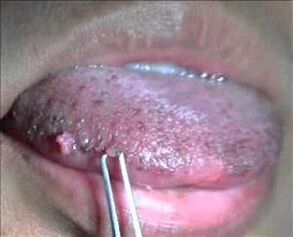papillomavirus humain sur la langue